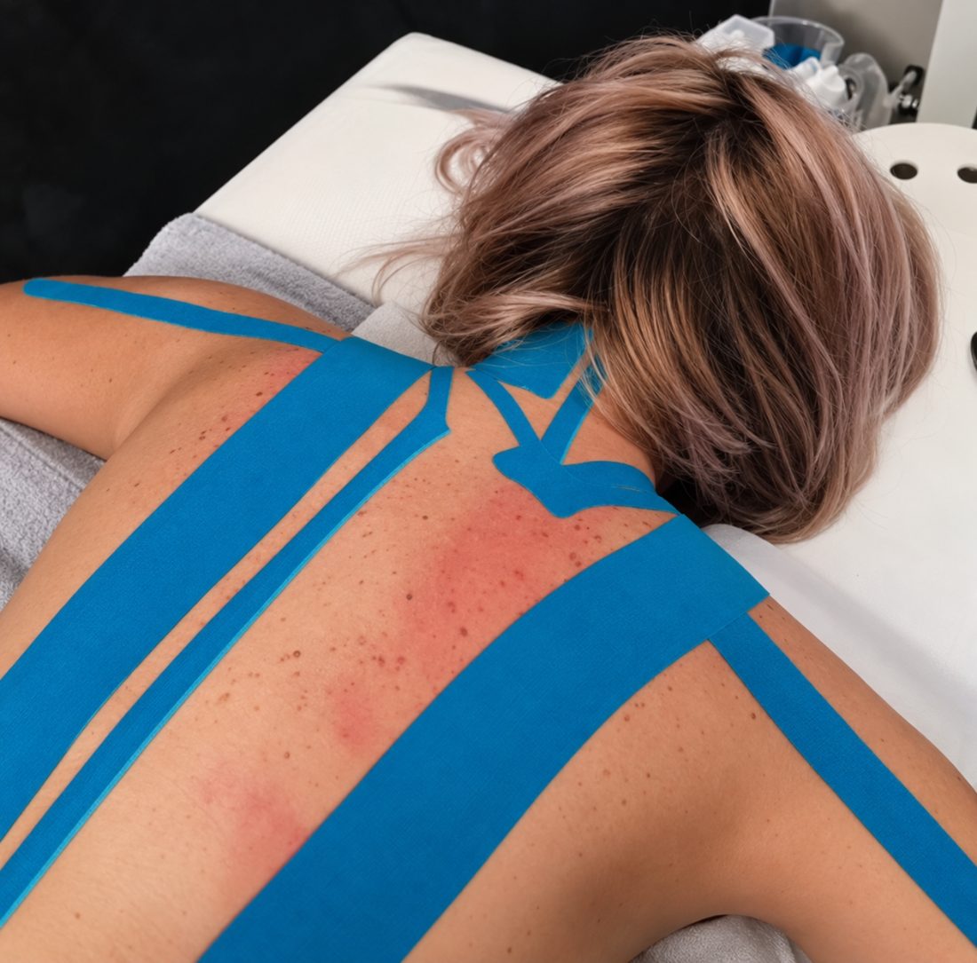 Applicazione di taping elastico sulla schiena